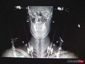 Motorcycle injury xray A Hangman's Fracture
